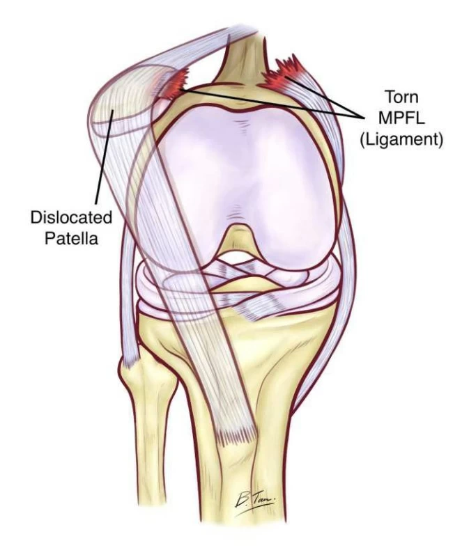 تفاصيل إصابة حمد اليامي لاعب الهلال ومستقبل موسمه