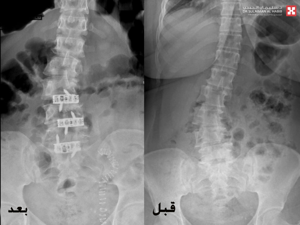 جراحة متقدمة لتعديل العمود الفقري بمستشفى الحبيب بالخبر
